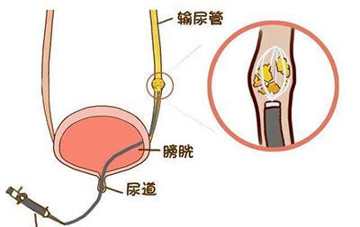 佛山结石，佛山泌尿结石，佛山结石医院